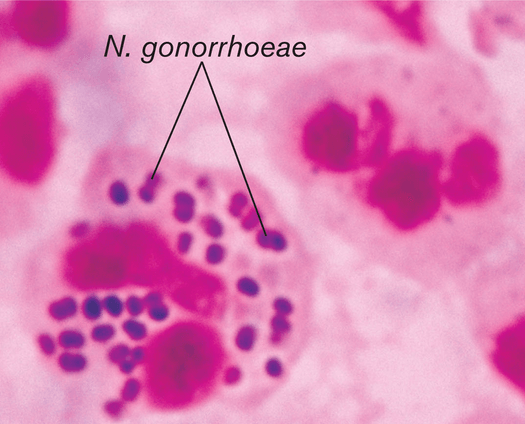 Nisseria gonorrhoeaeの顕微鏡写真